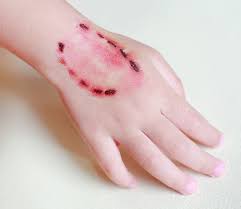 rabies bite